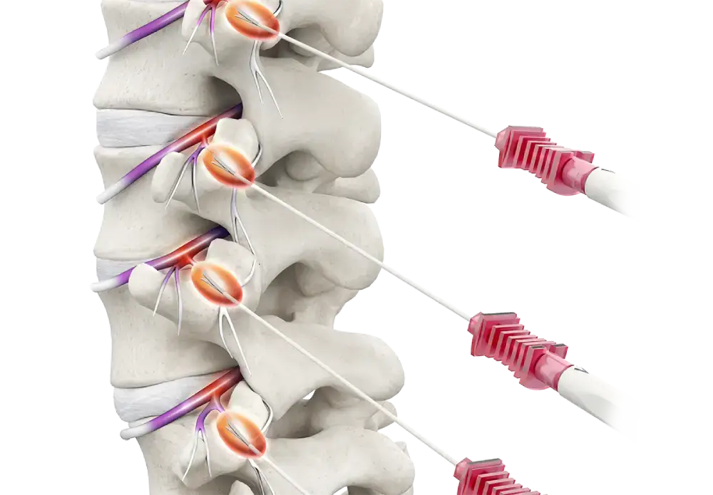 Radiofrequency Ablation (RFA)